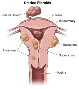 Fibroids Illustration UCLA